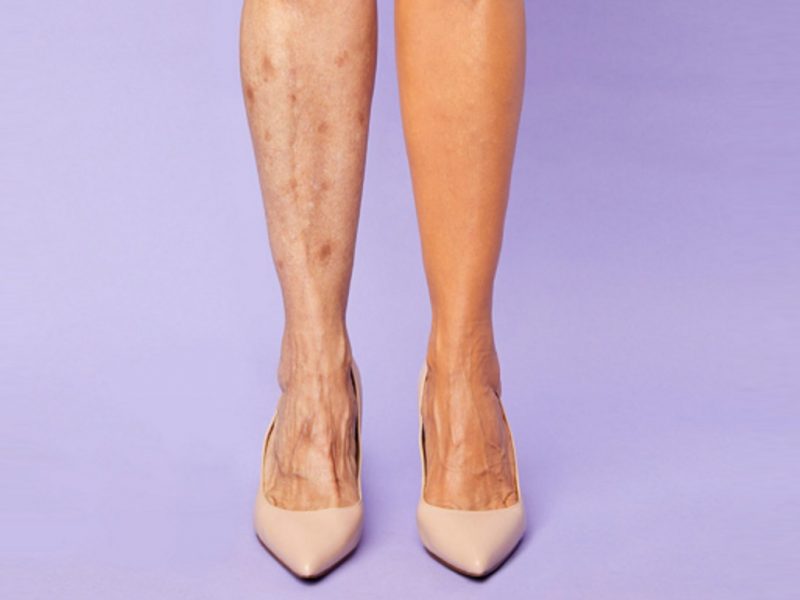 Shape Tape concealer legs varicose veins